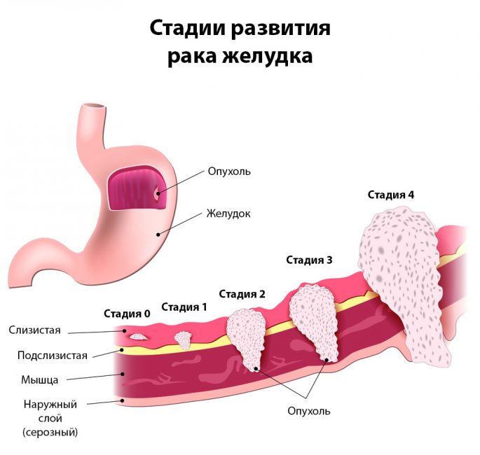 Стадии развития рака желудка