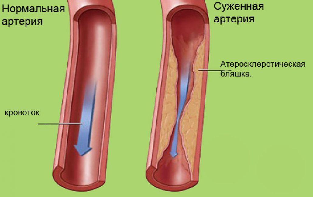 Сужение сосудов кожи. Сужение кровеносных сосудов. Чистка артерий и сосудов. Сужение кровеносных сосудов болезнь.