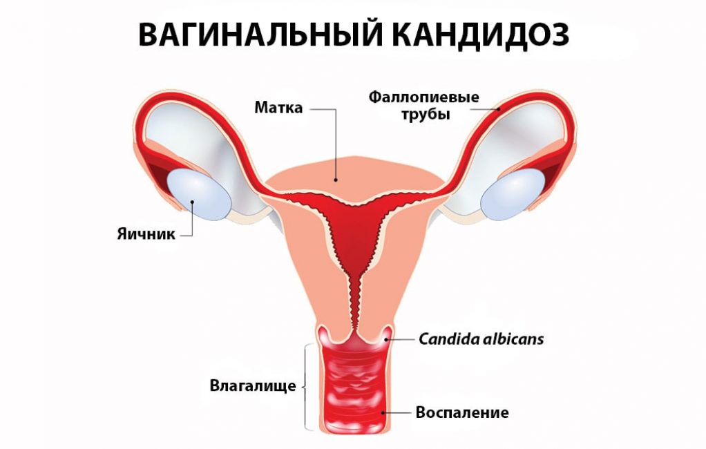 Развитие вагинального кандидоза