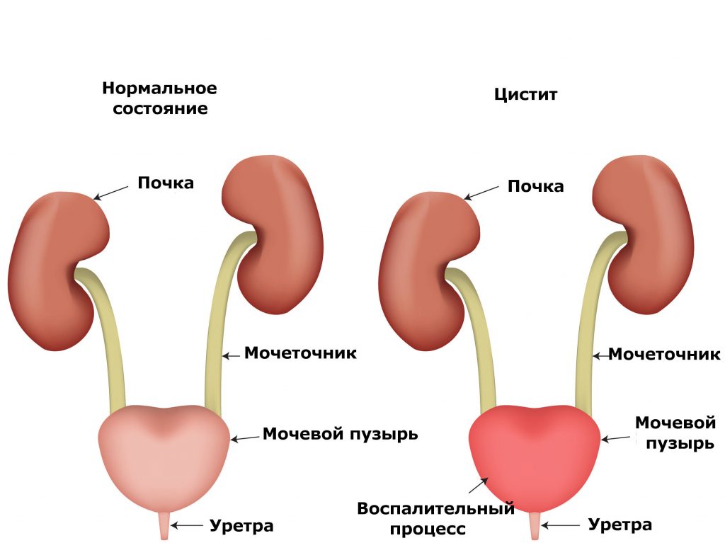 Частое Мочеиспускание: Причины + ТОП-5 Способов Лечения