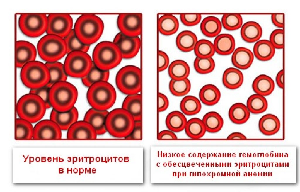 Цп эритроцитов. Гиперхромная анемия микроцитарная. При гипохромной анемии цветовой показатель:. Гипохромная железодефицитная анемия. Уровень эритроцитов прианеми.