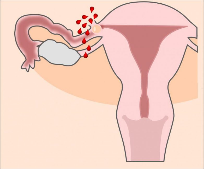 Внематочная или трубная беременность приводит к внутреннему кровотечению
