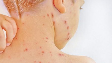 Ветрянка у детей: инкубационный период, первые симптомы, лечение + 60 ФОТО